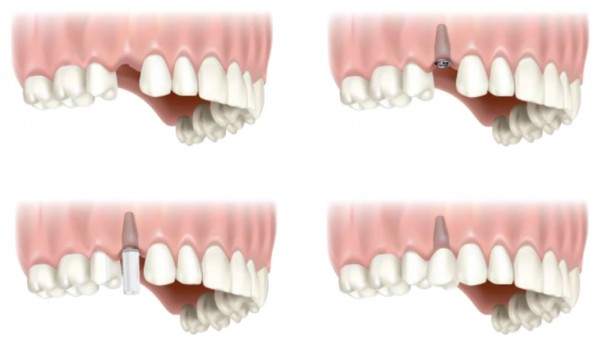 single-tooth-implant